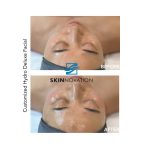 Custom facial before and after