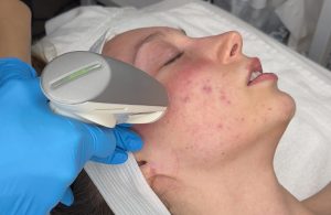 Young woman receiving skin resurfacing treatment